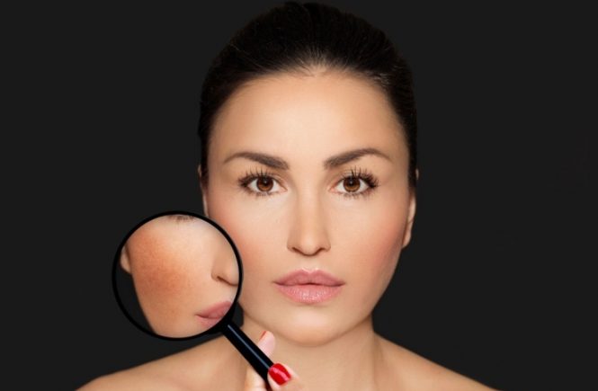 Three Home Remedies For Dark Spots And Uneven Skin Tone